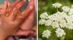 摸到白色植物，4岁女童手指发红长满水泡，澳洲郊外也有这种剧毒植物（组图）