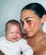 澳洲女子激光祛除孩子脸上胎记，却被网友群嘲是怪物妈妈？网友：站着说话不腰疼（组图）