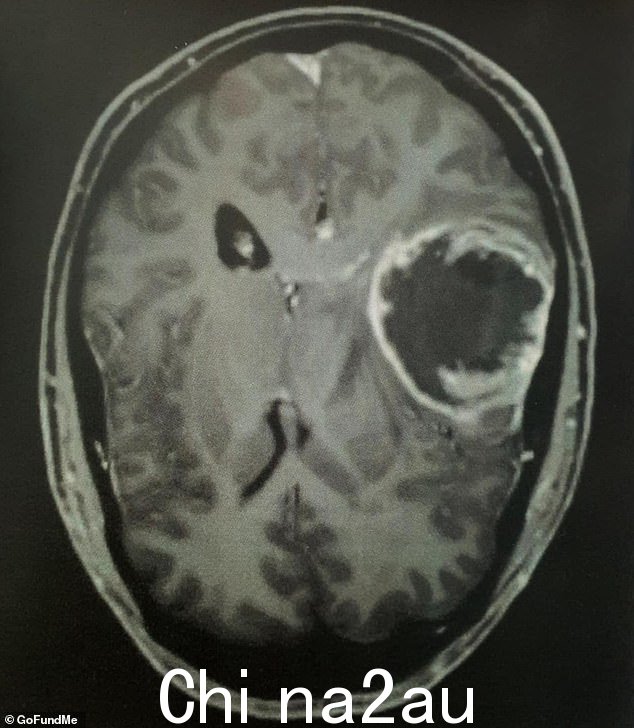 一个柑橘大小的肿瘤（如图）位于史密斯先生的右颞叶附近，这位两个孩子的父亲在第二天预约了紧急手术